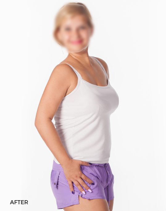 gastric-ballon-afters