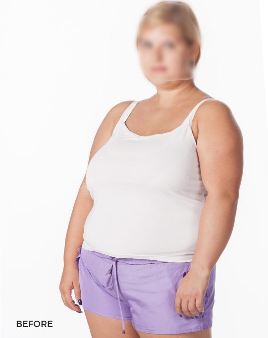 gastric-ballon-befores