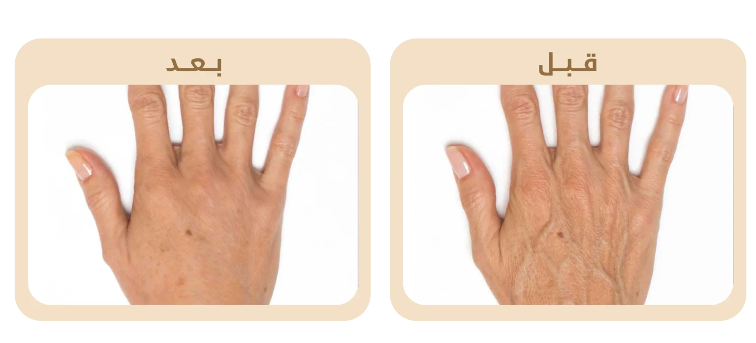 A1hand